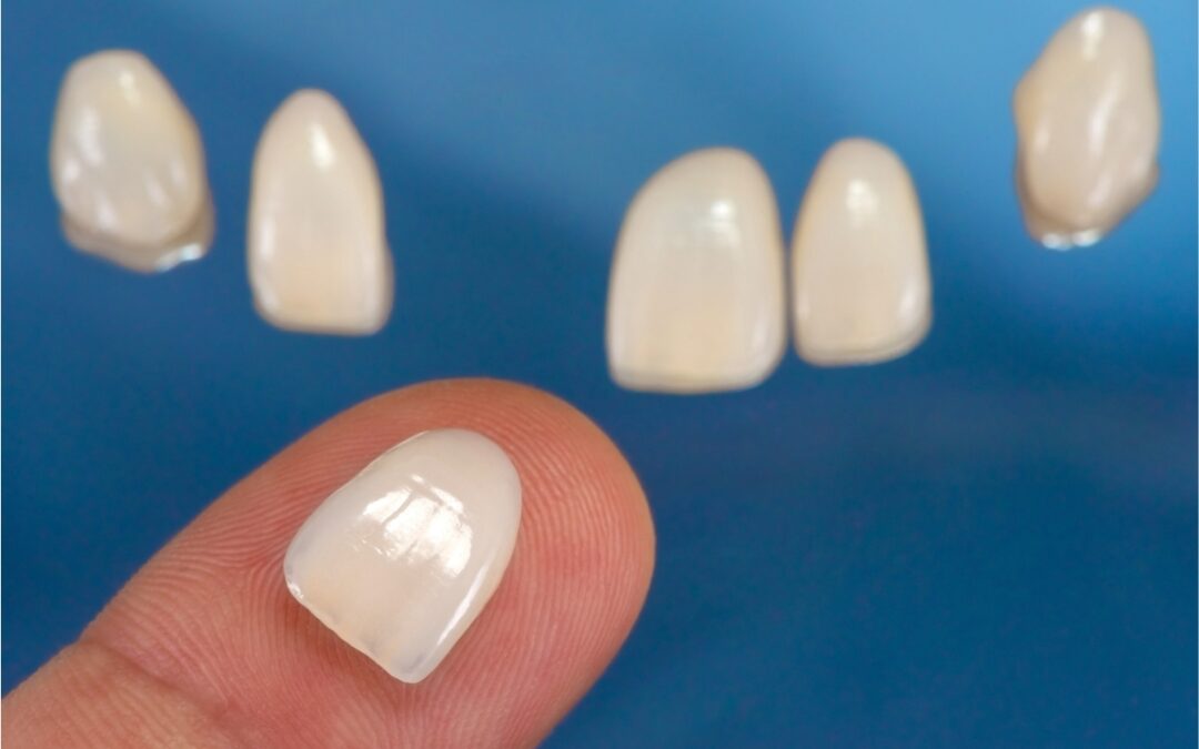 Can You Get Veneers If You Already Have A Dental Crown?