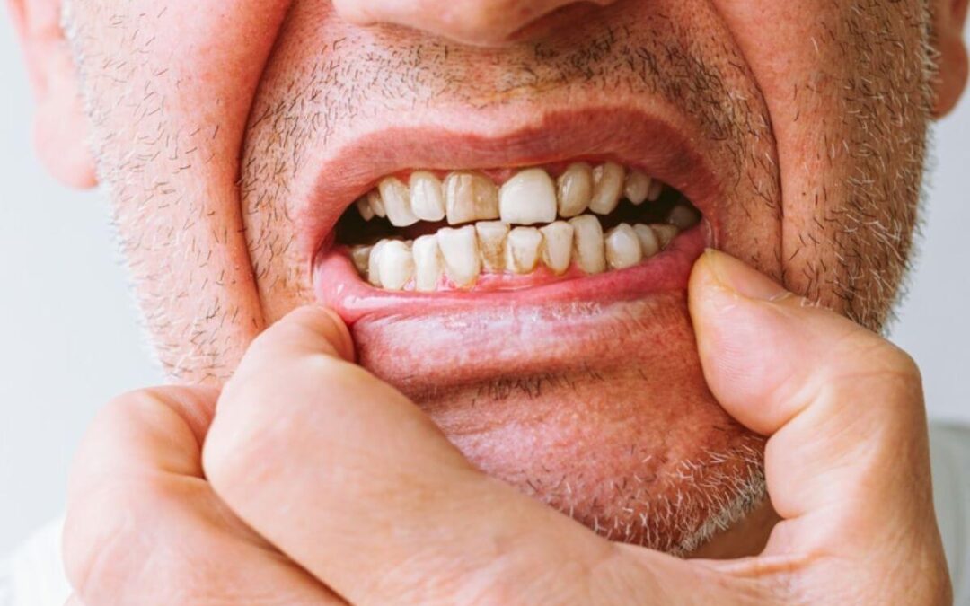 What Are Your Options if You Have Receding Gums?