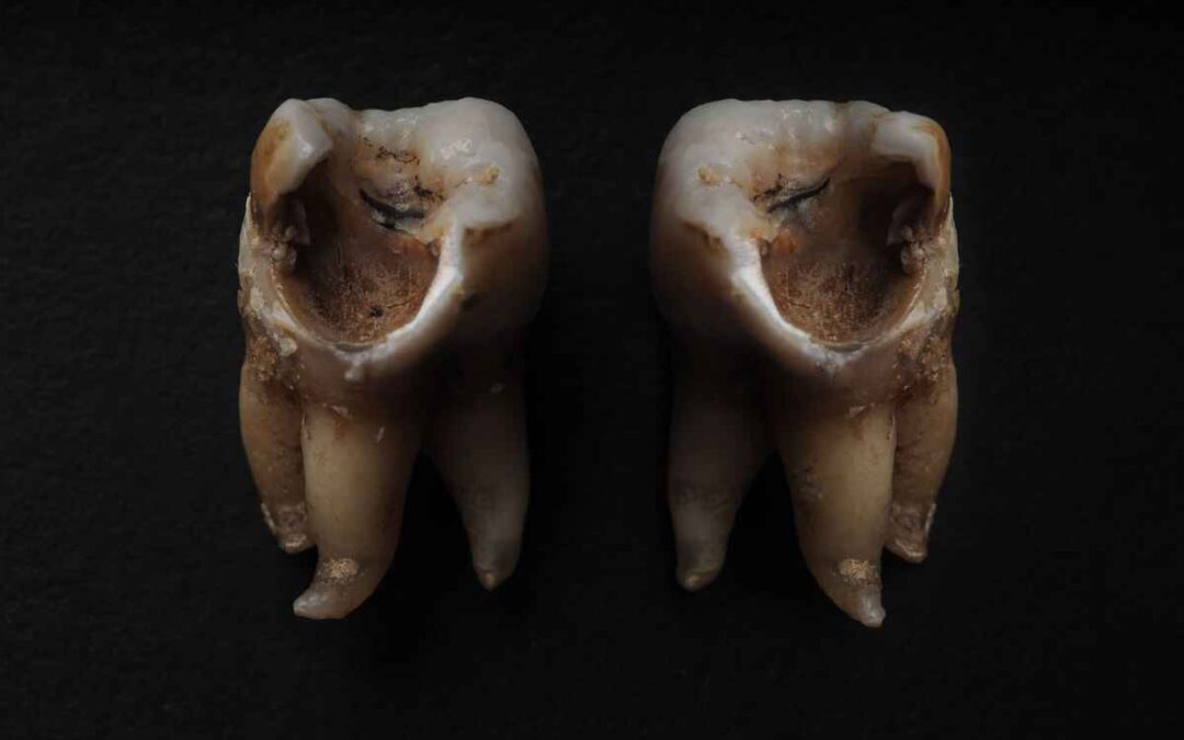 Can You Reverse Cavities with Proper Oral Care?