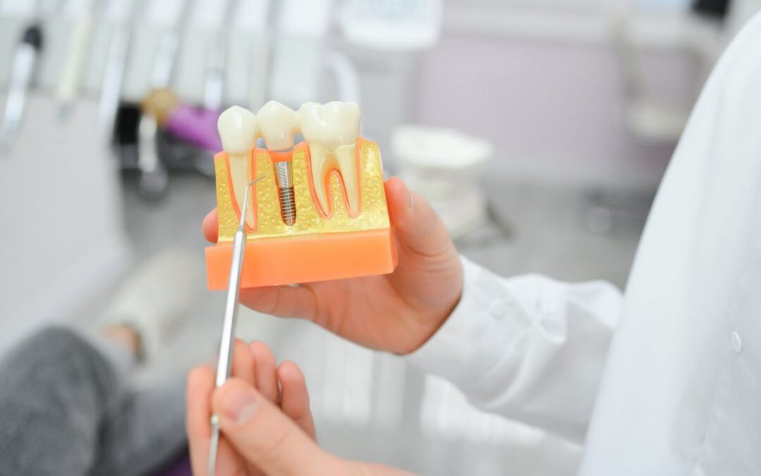 What Can Go Wrong With Dental Implants? Common Problems and How to Avoid Them