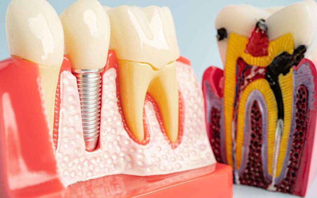 Dental Implant Aftercare: What You Need To Do (and What Not) in the First 30 Days