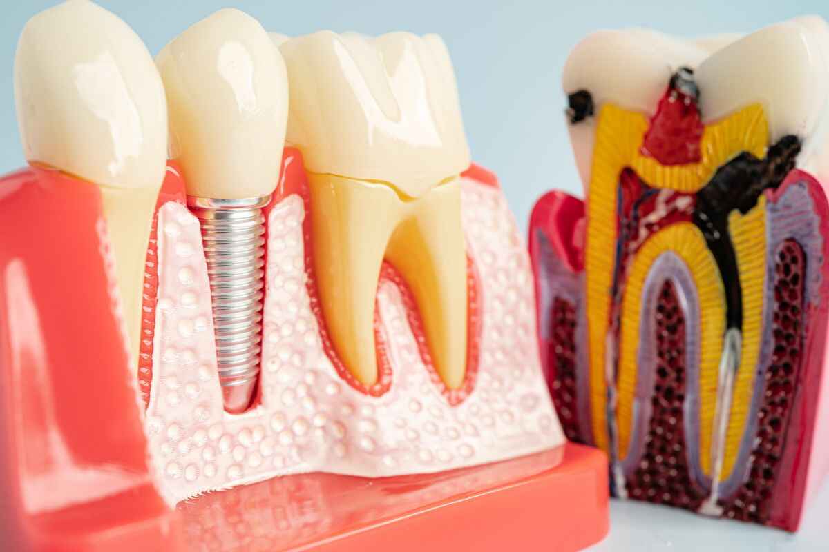 dental implant aftercare first 30 days A diagram showing healthy dental implants as part of a 30-day aftercare recovery plan