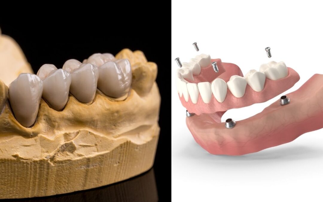 Dental Implants vs Bridges: Which Tooth Replacement Option Is Right for You?