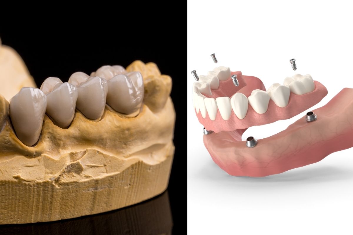 dental implants vs bridges comparison Side-by-side comparison of a multi-unit dental bridge on a stone model and an implant-supported full-arch prosthesis diagram