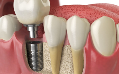 Dental Implants Houston: What to Know Before Starting Treatment