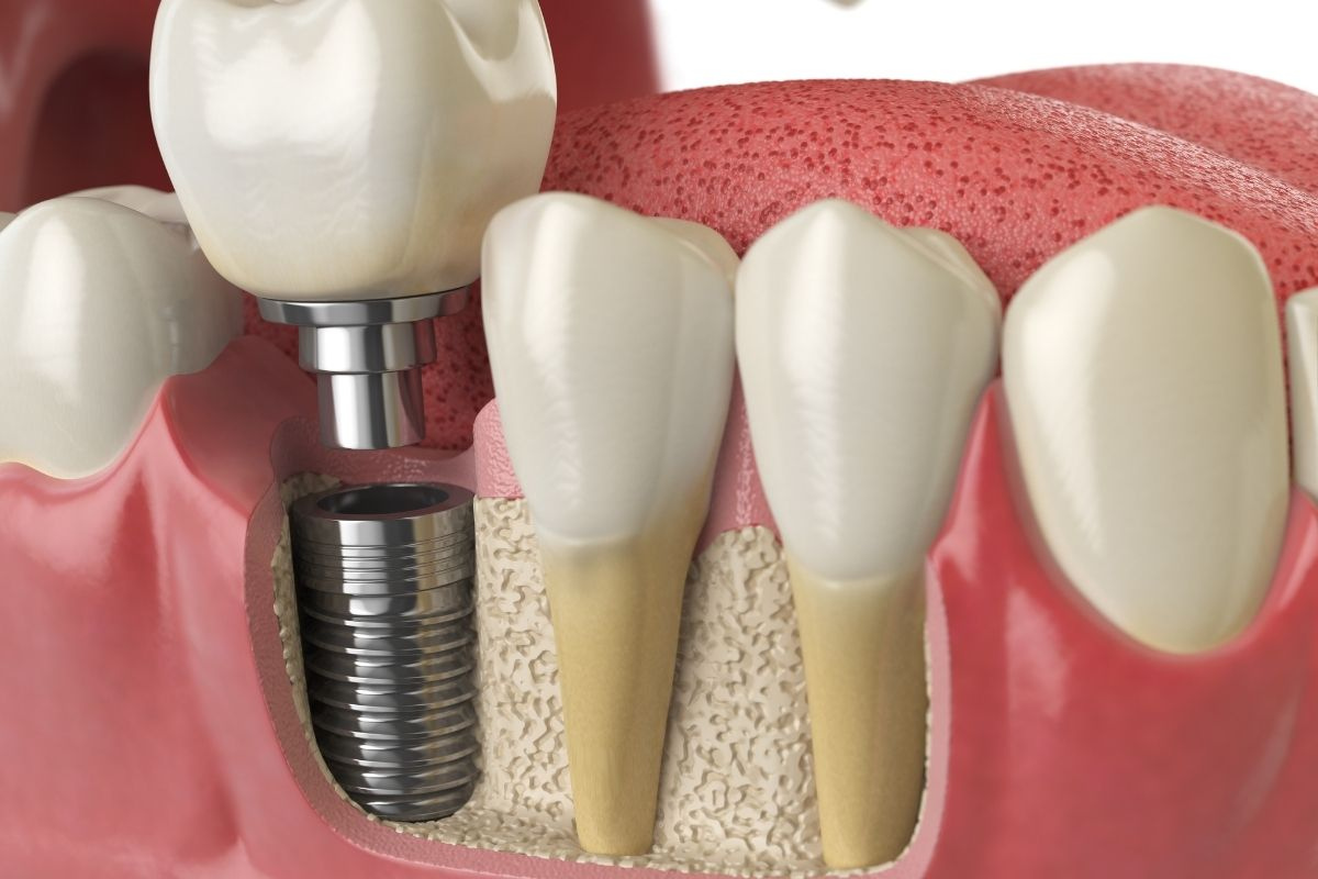 Dental implant placement and restoration process illustration
